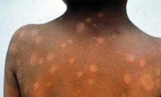 Credit Photo: pinterest.com | Leprosy & NTDs